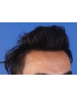 After Hair Transplant &nbsp;Front